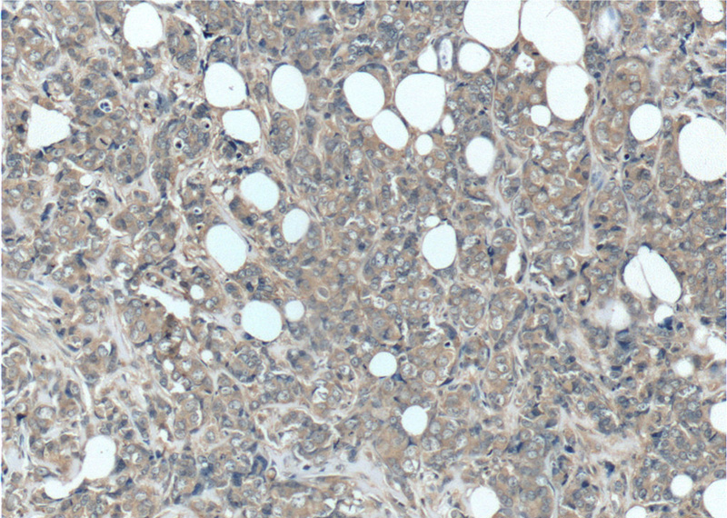 Immunohistochemistry of paraffin-embedded human breast cancer tissue slide using Catalog No:110970(GIGYF2 Antibody) at dilution of 1:50 (under 10x lens)