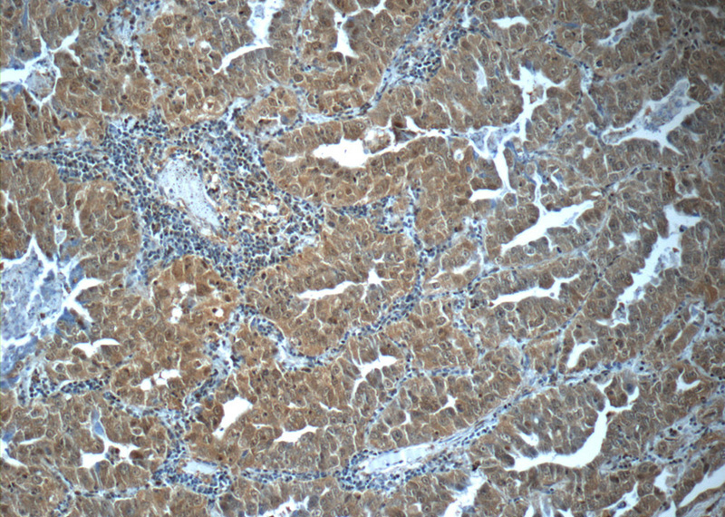 Immunohistochemistry of paraffin-embedded human lung cancer tissue slide using Catalog No:111099(GMFG Antibody) at dilution of 1:50 (under 10x lens)