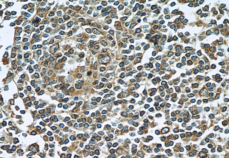 Immunohistochemistry of paraffin-embedded human tonsillitis tissue slide using Catalog No:112399(LY6E Antibody) at dilution of 1:50 (under 40x lens)