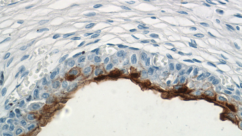 Immunohistochemistry of paraffin-embedded human bladder tissue slide using Catalog No:116631(UPK3B Antibody) at dilution of 1:100 (under 40x lens)
