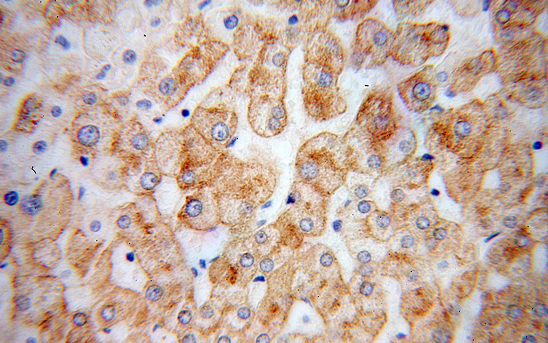 Immunohistochemical of paraffin-embedded human liver cancer using Catalog No:108226(ASGR1 antibody) at dilution of 1:100 (under 40x lens)