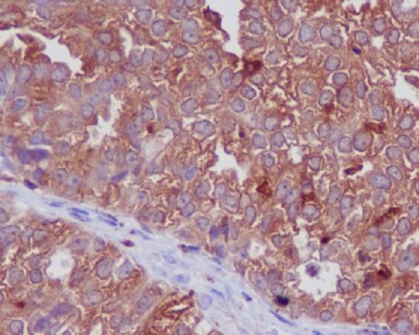 Immunohistochemical analysis of paraffin-embedded human ovarian cancer, using Cathepsin D Antibody.