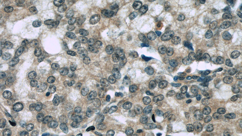 Immunohistochemistry of paraffin-embedded human prostate cancer slide using Catalog No:116414(TRPS1 Antibody) at dilution of 1:50