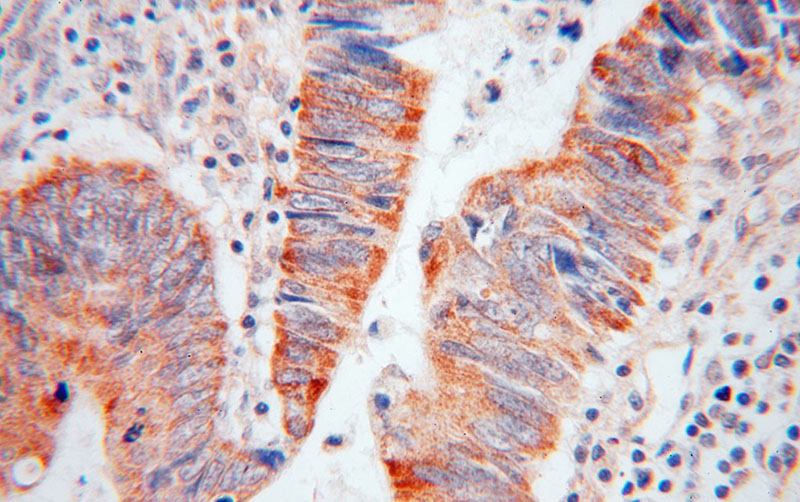 Immunohistochemical of paraffin-embedded human colon cancer using Catalog No:114441(RAB3B antibody) at dilution of 1:50 (under 40x lens)