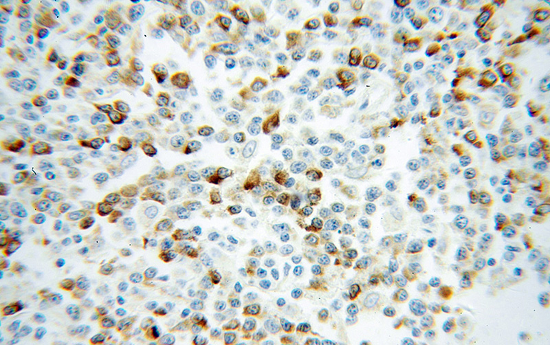Immunohistochemical of paraffin-embedded human lymphoma using Catalog No:112627(MIP­3β antibody) at dilution of 1:100 (under 40x lens)