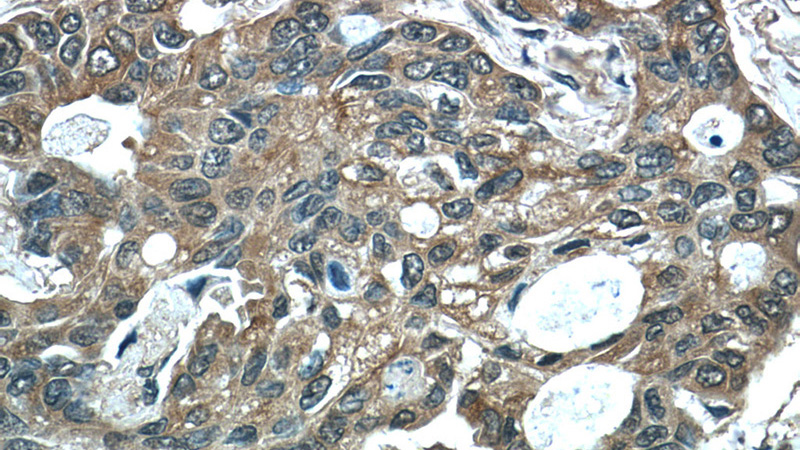Immunohistochemistry of paraffin-embedded human lung cancer tissue slide using Catalog No:107557(TUBA1A(ace-40Lys) Antibody) at dilution of 1:50 (under 40x lens)