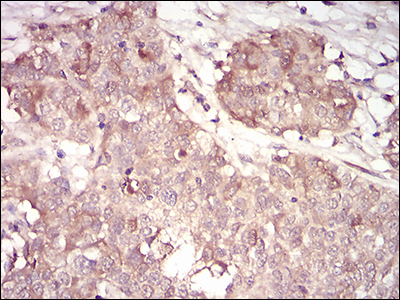 Immunohistochemical analysis of paraffin-embedded bladder cancer tissues using CCNA2 mouse mAb with DAB staining.