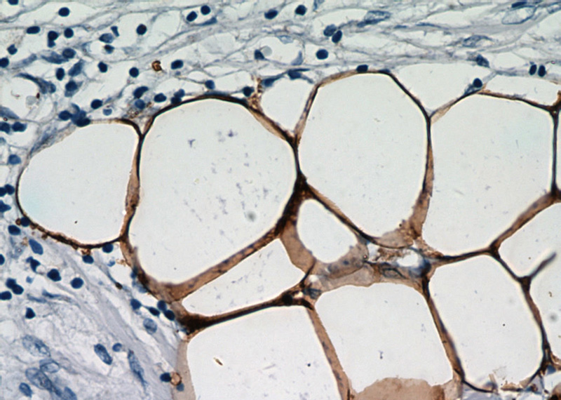 Immunohistochemical of paraffin-embedded human breast cancer using Catalog No:110440(FABP4 antibody) at dilution of 1:50 (under 40x lens)