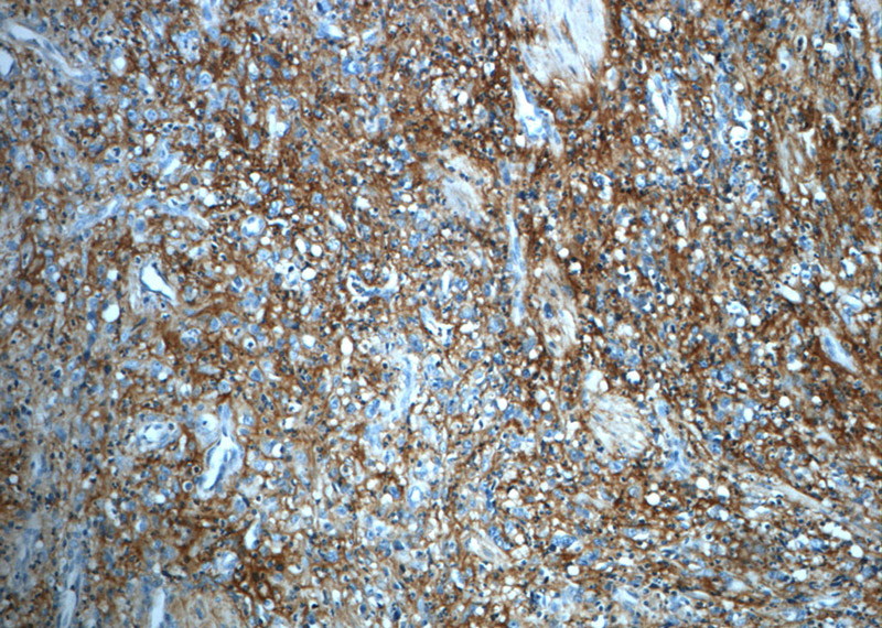 Immunohistochemistry of paraffin-embedded human stomach cancer slide using Catalog No:111948(ITIH3 Antibody) at dilution of 1:50