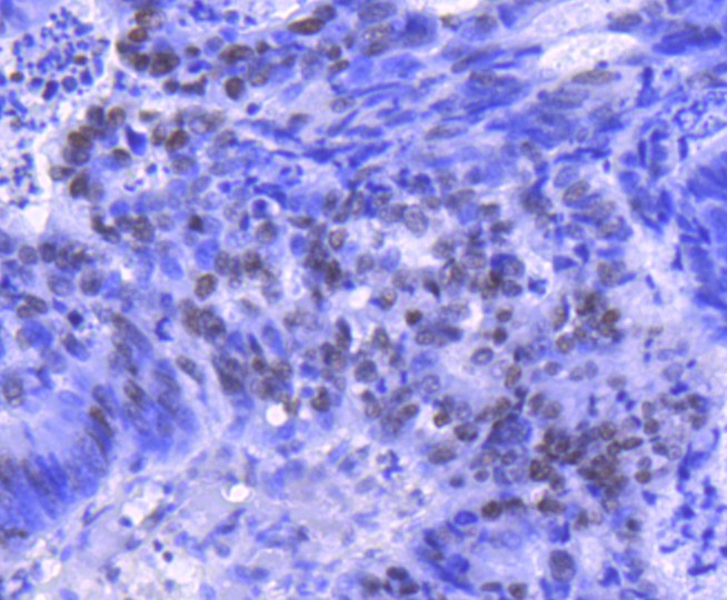 Fig6: Immunohistochemical analysis of paraffin-embedded human colon cancer tissue using anti-Histone H2B(acetyl K20) antibody. Counter stained with hematoxylin.