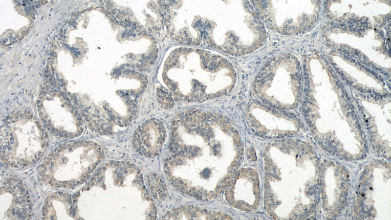 Immunohistochemical of paraffin-embedded human prostate hyperplasia using Catalog No:114021(PMEPA1 antibody) at dilution of 1:50 (under 10x lens)