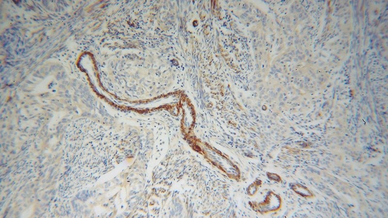 Immunohistochemical of paraffin-embedded human endometrial cancer using Catalog No:116207(TPM4 antibody) at dilution of 1:100 (under 10x lens)