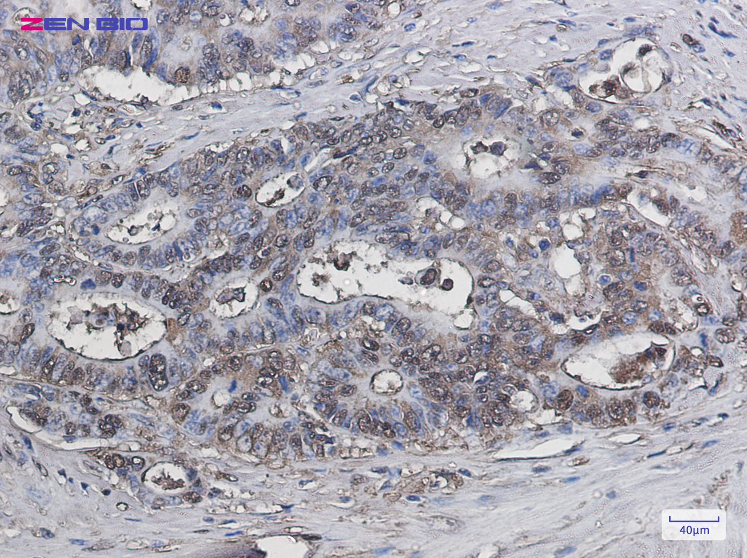 Immunohistochemistry of Galectin 3 in paraffin-embedded Human colon cancer tissue using Galectin 3 Rabbit pAb at dilution 1/50