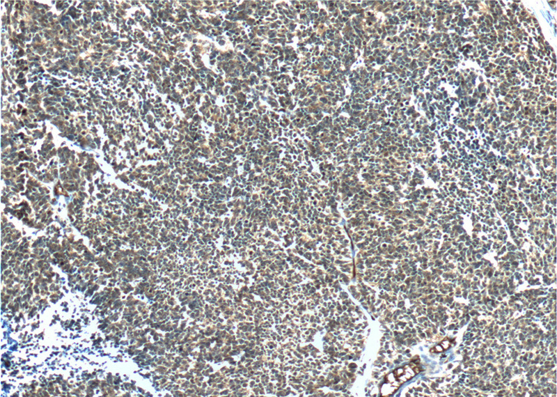 Immunohistochemistry of paraffin-embedded human lung cancer tissue slide using Catalog No:113538(P16-INK4A Antibody) at dilution of 1:200 (under 10x lens).