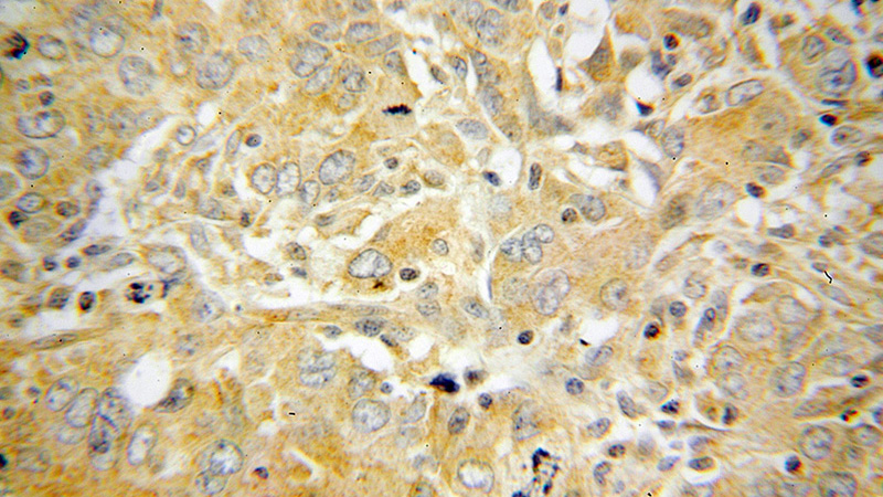 Immunohistochemical of paraffin-embedded human breast cancer using Catalog No:113560(p70(S6K) antibody) at dilution of 1:100 (under 40x lens)