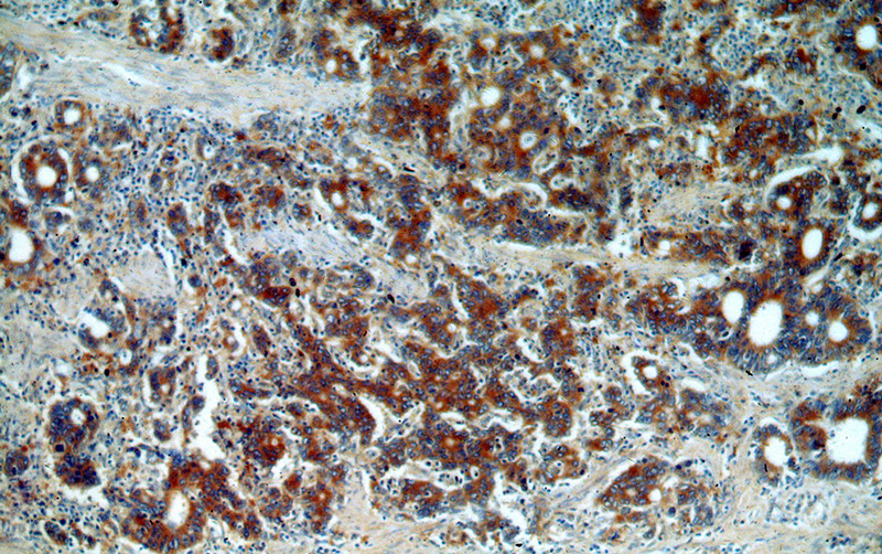 Immunohistochemical of paraffin-embedded human stomach cancer using Catalog No:110316(EEF2 antibody) at dilution of 1:100 (under 10x lens)