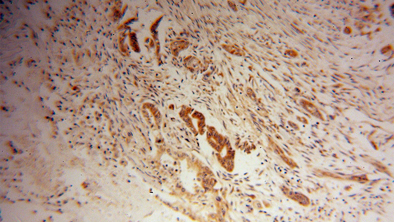 Immunohistochemical of paraffin-embedded human pancreas cancer using Catalog No:116554(UGCGL1 antibody) at dilution of 1:100 (under 10x lens)