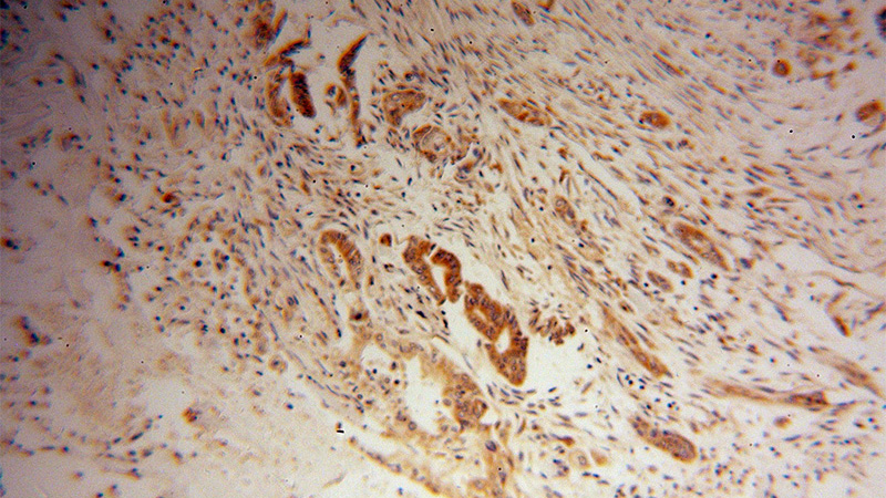 Immunohistochemical of paraffin-embedded human pancreas cancer using Catalog No:116554(UGCGL1 antibody) at dilution of 1:100 (under 10x lens)