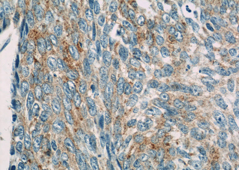 Immunohistochemistry of paraffin-embedded human skin cancer slide using Catalog No:111159(PCDGF,GRN Antibody) at dilution of 1:50