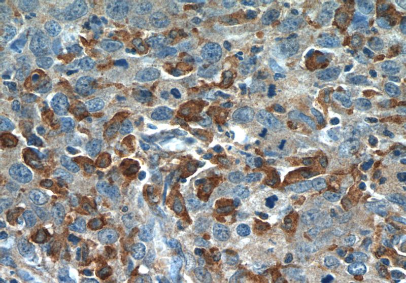 Immunohistochemistry of paraffin-embedded human cervical cancer tissue slide using Catalog No:113965(PLEKHO2 Antibody) at dilution of 1:50 (under 40x lens)