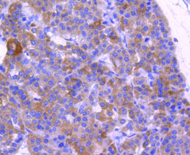 Fig7: Immunohistochemical analysis of paraffin-embedded human liver cancer tissue using anti-ABCF1 antibody. Counter stained with hematoxylin.