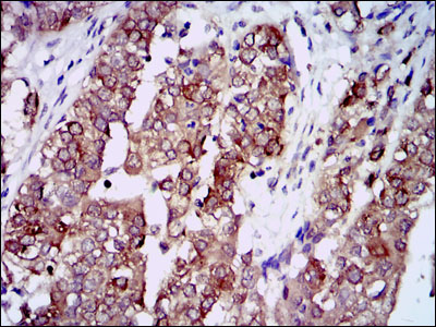 Immunohistochemical analysis of paraffin-embedded bladder cancer tissues using HSP90AA1 mouse mAb with DAB staining.