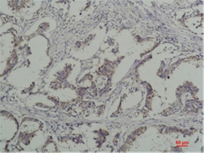 Immunohistochemical analysis of paraffin-embedded Human Breast Caricnoma using PhosphotyrosineMouse mAb diluted at 1:200.