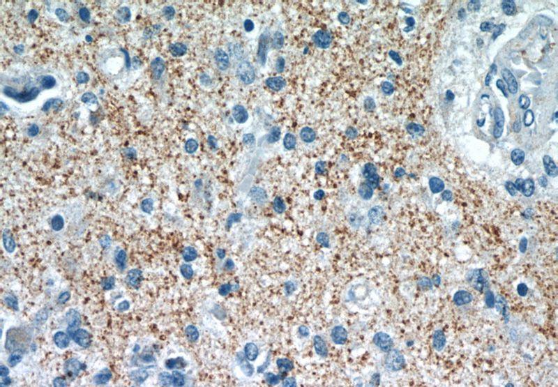 Immunohistochemistry of paraffin-embedded human gliomas tissue slide using Catalog No:115770(SYNPR Antibody) at dilution of 1:50