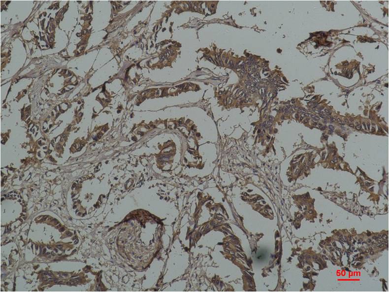 Immunohistochemical analysis of paraffin-embedded Human Breast Caricnoma using HSP27 Mouse mAb diluted at 1:200.