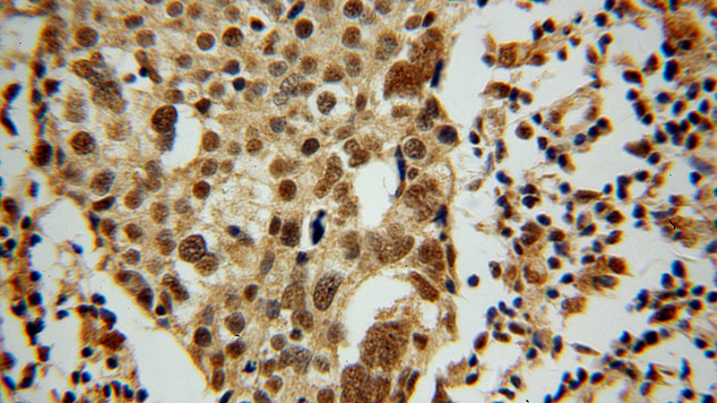 Immunohistochemical of paraffin-embedded human ovary tumor using Catalog No:112880(YBX2 antibody) at dilution of 1:50 (under 40x lens)