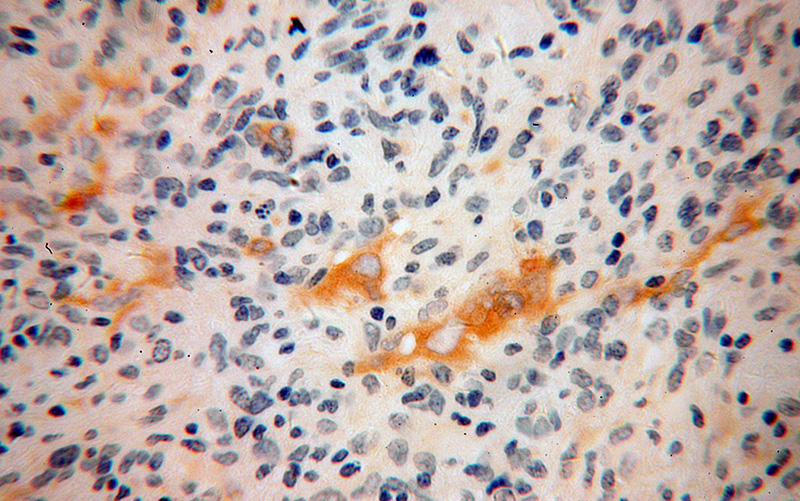 Immunohistochemical of paraffin-embedded human gliomas using Catalog No:110951(GFPT1 antibody) at dilution of 1:100 (under 40x lens)