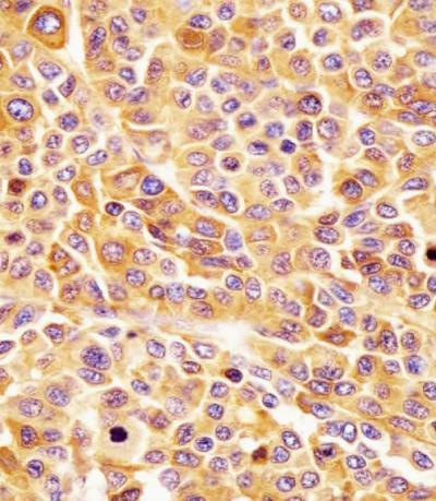AP5333B staining CD63 in human melanoma tissue sections by Immunohistochemistry (IHC-P - paraformaldehyde-fixed,  paraffin-embedded sections).  Tissue was fixed with formaldehyde and blocked with 3% BSA for 0. 5 hour at room temperature; antigen retrieval