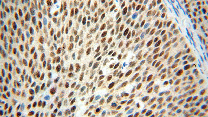 Immunohistochemical of paraffin-embedded human cervical cancer using Catalog No:111507(HNRNPH1 antibody) at dilution of 1:50 (under 40x lens)