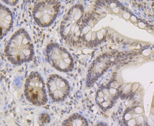 Fig6:; Immunohistochemical analysis of paraffin-embedded human small intestine tissue using anti-TNPO3 antibody. The section was pre-treated using heat mediated antigen retrieval with sodium citrate buffer (pH 6.0) for 20 minutes. The tissues were blocked in 5% BSA for 30 minutes at room temperature, washed with ddH; 2; O and PBS, and then probed with the primary antibody ( 1/50) for 30 minutes at room temperature. The detection was performed using an HRP conjugated compact polymer system. DAB was used as the chromogen. Tissues were counterstained with hematoxylin and mounted with DPX.