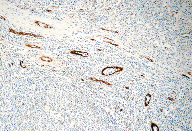 Immunohistochemistry of paraffin-embedded human tonsillitis tissue slide using Catalog No:108957(CCBP2 Antibody) at dilution of 1:1200 (under 10x lens)