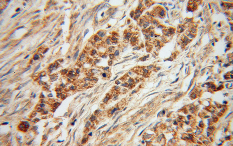 Immunohistochemical of paraffin-embedded human endometrial cancer using Catalog No:112192(LEFTY2 antibody) at dilution of 1:50 (under 40x lens)