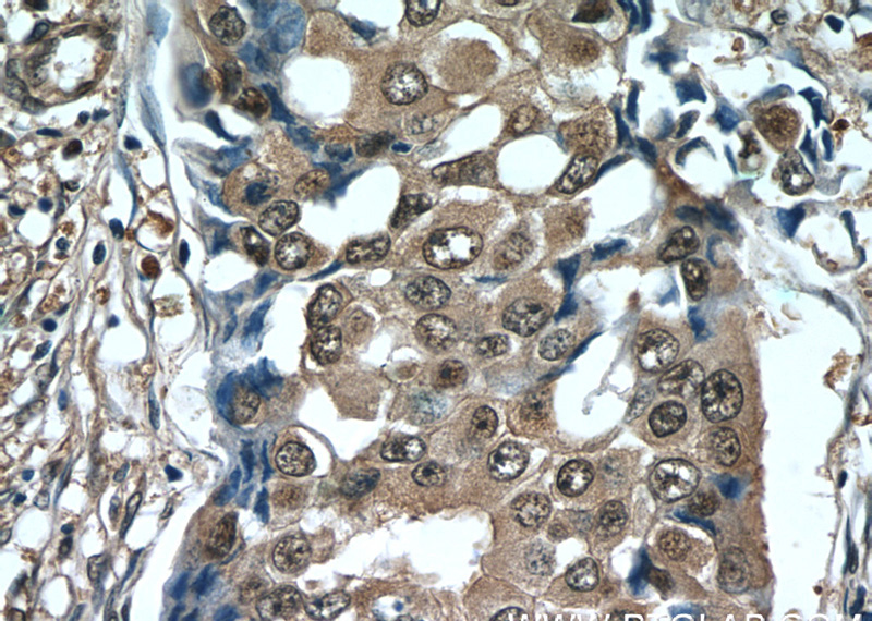 Immunohistochemistry of paraffin-embedded human breast cancer tissue slide using Catalog No:114536(RAN Antibody) at dilution of 1:50 (under 40x lens)