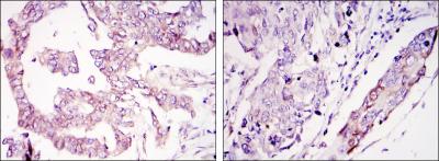 Immunohistochemical analysis of paraffin-embedded ovary tumour tissues (left) and lung cancer (right) using WIF1 mouse mAb with DAB staining.