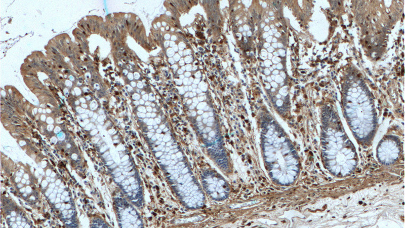 Immunohistochemistry of paraffin-embedded human colon tissue slide using Catalog No:107294(Gelsolin Antibody) at dilution of 1:200 (under 10x lens).