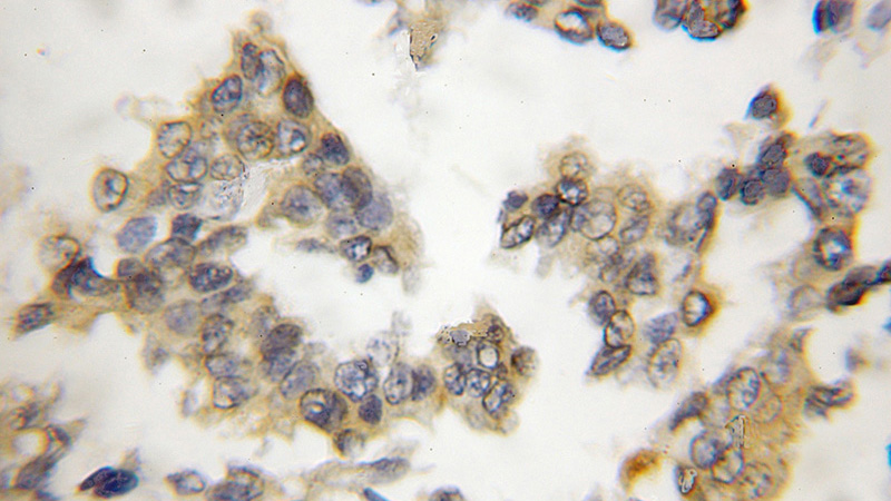 Immunohistochemical of paraffin-embedded human breast cancer using Catalog No:109311(CIB1 antibody) at dilution of 1:50 (under 10x lens)