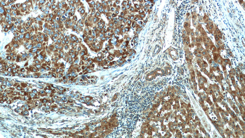 Immunohistochemical of paraffin-embedded human liver cancer using Catalog No:109530(CPT1A antibody) at dilution of 1:100 (under 10x lens)