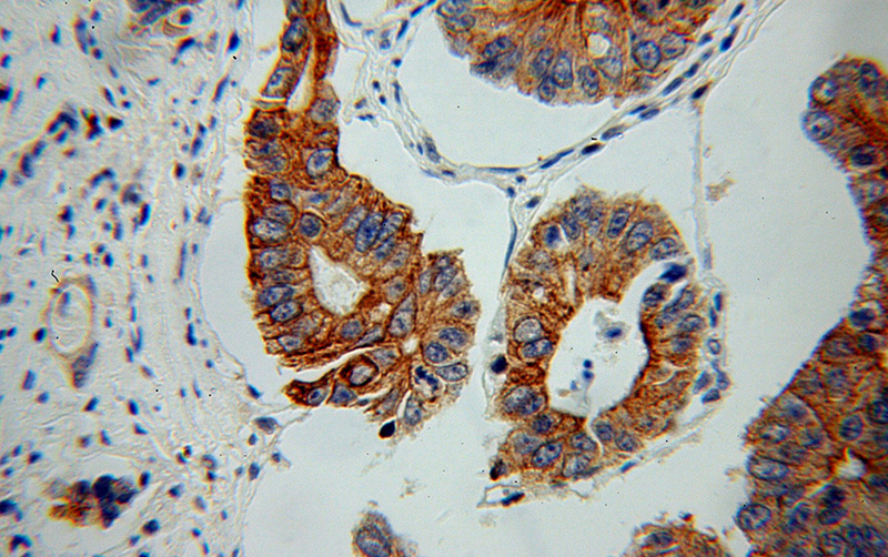 Immunohistochemical of paraffin-embedded human colon cancer using Catalog No:113582(PARD3 antibody) at dilution of 1:50 (under 40x lens)