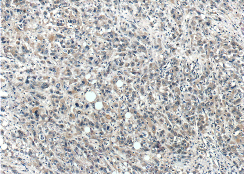 Immunohistochemistry of paraffin-embedded human stomach cancer tissue slide using Catalog No:116684(USP45 Antibody) at dilution of 1:200 (under 10x lens).
