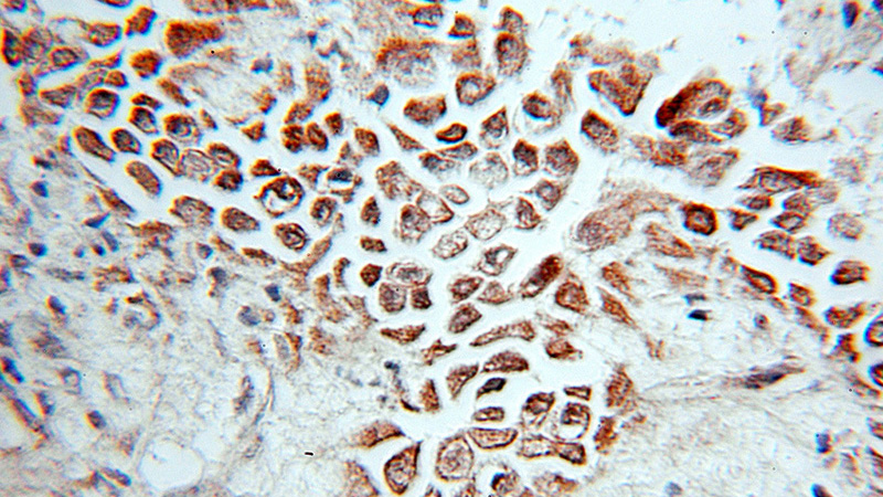 Immunohistochemical of paraffin-embedded human ovary tumor using Catalog No:116516(UBE2B antibody) at dilution of 1:10 (under 10x lens)