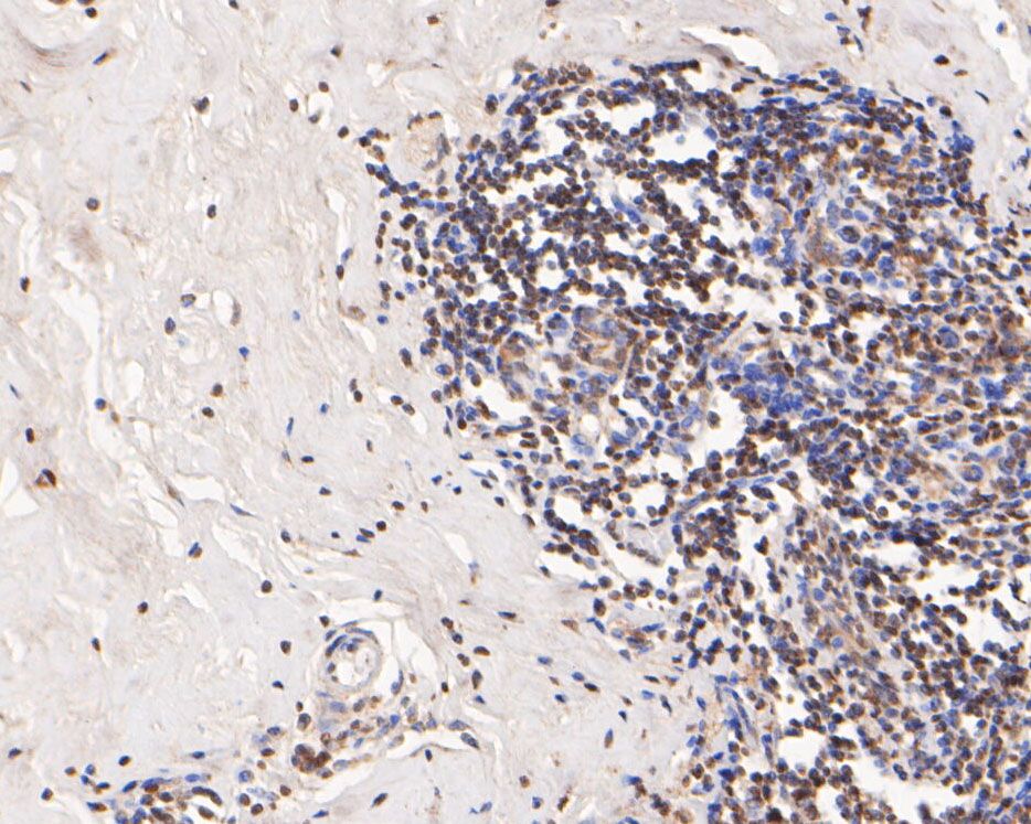 Fig2:; Immunohistochemical analysis of paraffin-embedded human breast cancer tissue using anti-Histone H3 antibody. The section was pre-treated using heat mediated antigen retrieval with sodium citrate buffer (pH 6.0) for 20 minutes. The tissues were blocked in 5% BSA for 30 minutes at room temperature, washed with ddH; 2; O and PBS, and then probed with the primary antibody ( 1/400) for 30 minutes at room temperature. The detection was performed using an HRP conjugated compact polymer system. DAB was used as the chromogen. Tissues were counterstained with hematoxylin and mounted with DPX.