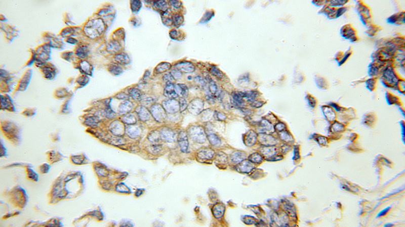 Immunohistochemical of paraffin-embedded human breast cancer using Catalog No:110197(EIF3I antibody) at dilution of 1:100 (under 10x lens)
