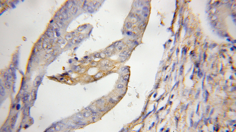 Immunohistochemical of paraffin-embedded human colon cancer using Catalog No:109067(PDCD10 antibody) at dilution of 1:50 (under 10x lens)