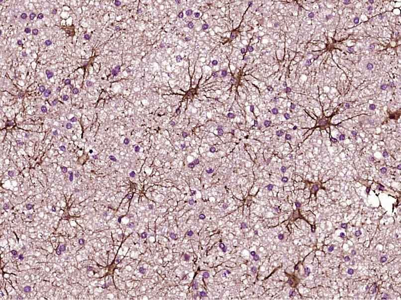 Fig2: Paraformaldehyde-fixed, paraffin embedded (Human brain glioma); Antigen retrieval by boiling in sodium citrate buffer (pH6.0) for 15min; Block endogenous peroxidase by 3% hydrogen peroxide for 20 minutes; Blocking buffer (normal goat serum) at 37℃ for 30min; Antibody incubation with (TIMP-1) Polyclonal Antibody, Unconjugated at 1:400 overnight at 4℃, followed by operating according to SP Kit(Mouse) (sp-0024) instructionsand DAB staining.