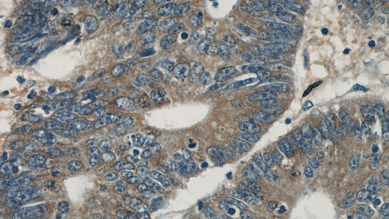 Immunohistochemical of paraffin-embedded human colon cancer using Catalog No:112188(LDLR antibody) at dilution of 1:50 (under 40x lens)