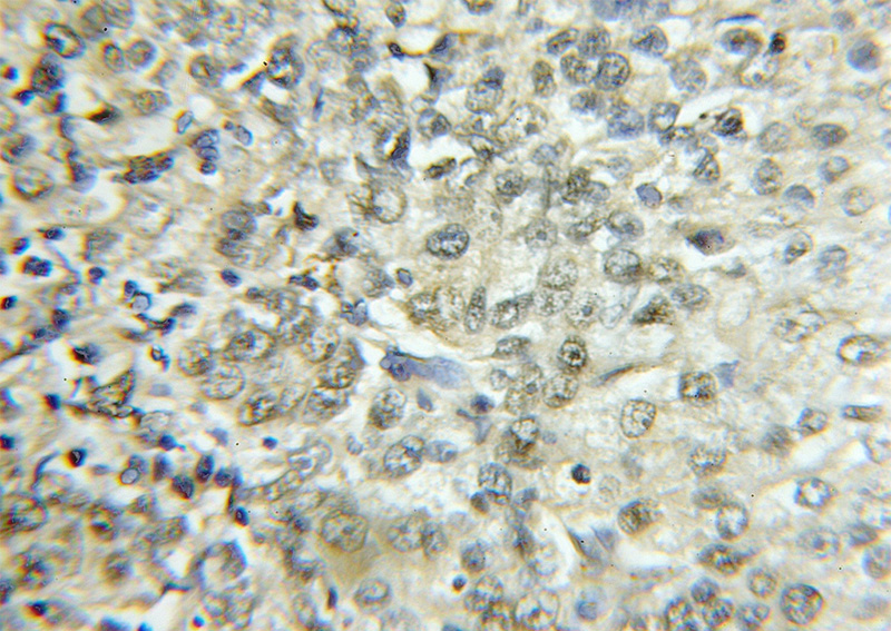 Immunohistochemical of paraffin-embedded human lung cancer using Catalog No:110224(EHD2 antibody) at dilution of 1:50 (under 10x lens)